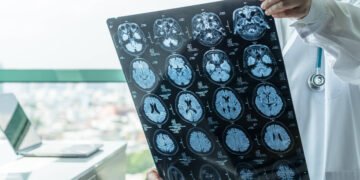 Tratamento prevê melhora de 70% nos tremores de Parkinson – 28/03/2025 – Equilíbrio e Saúde