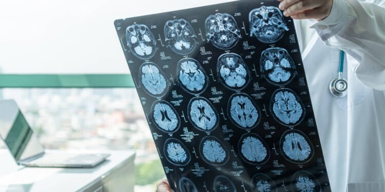 Tratamento prevê melhora de 70% nos tremores de Parkinson – 28/03/2025 – Equilíbrio e Saúde
