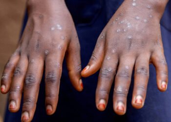 Mulher com nova cepa de mpox recebe alta em São Paulo – 13/03/2025 – Equilíbrio e Saúde