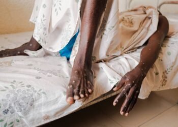 SP confirma primeiro caso de nova cepa de Mpox no Brasil – 07/03/2025 – Equilíbrio e Saúde