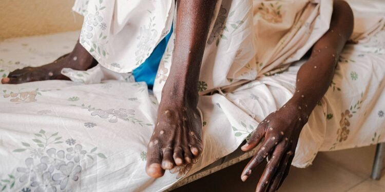 SP confirma primeiro caso de nova cepa de Mpox no Brasil – 07/03/2025 – Equilíbrio e Saúde