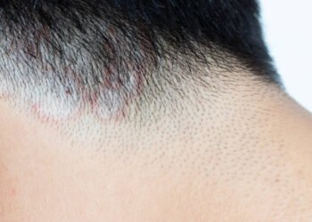 Fungo altamente transmissível é identificado no Brasil – 01/04/2025 – Equilíbrio e Saúde