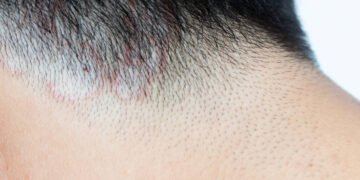 Fungo altamente transmissível é identificado no Brasil – 01/04/2025 – Equilíbrio e Saúde